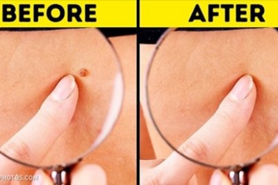 8 Home-Made Remedies That Will Help You Get Rid Of Skin Tags